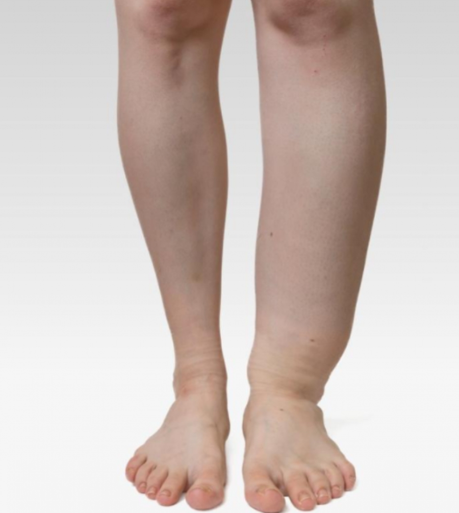 изтичане на лимфна течност от краката лечение