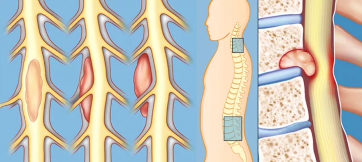 Тумори на гръбначния мозък — Medconsult.bg