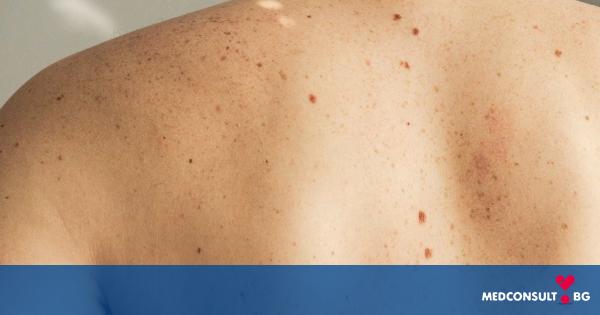 Меланомът е най-агресивният рак на кожата