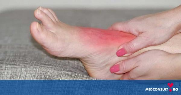 Подаграта е една от най-болезнените форми на артрит